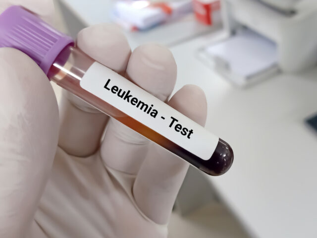 Leukemija – Šta treba da znate o ovoj bolesti?