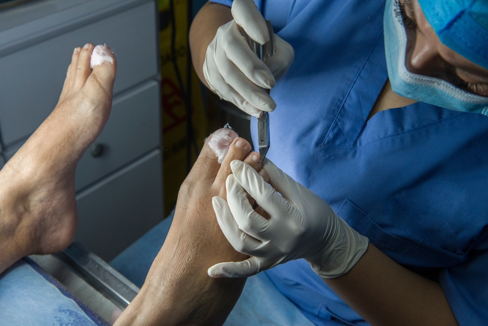 hiruško rešavanje uraslog nokta