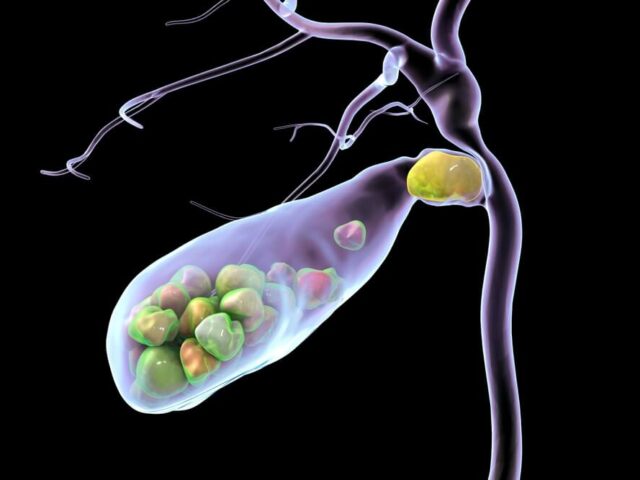 Kamen u žuči – Uzroci, simptomi i lečenje